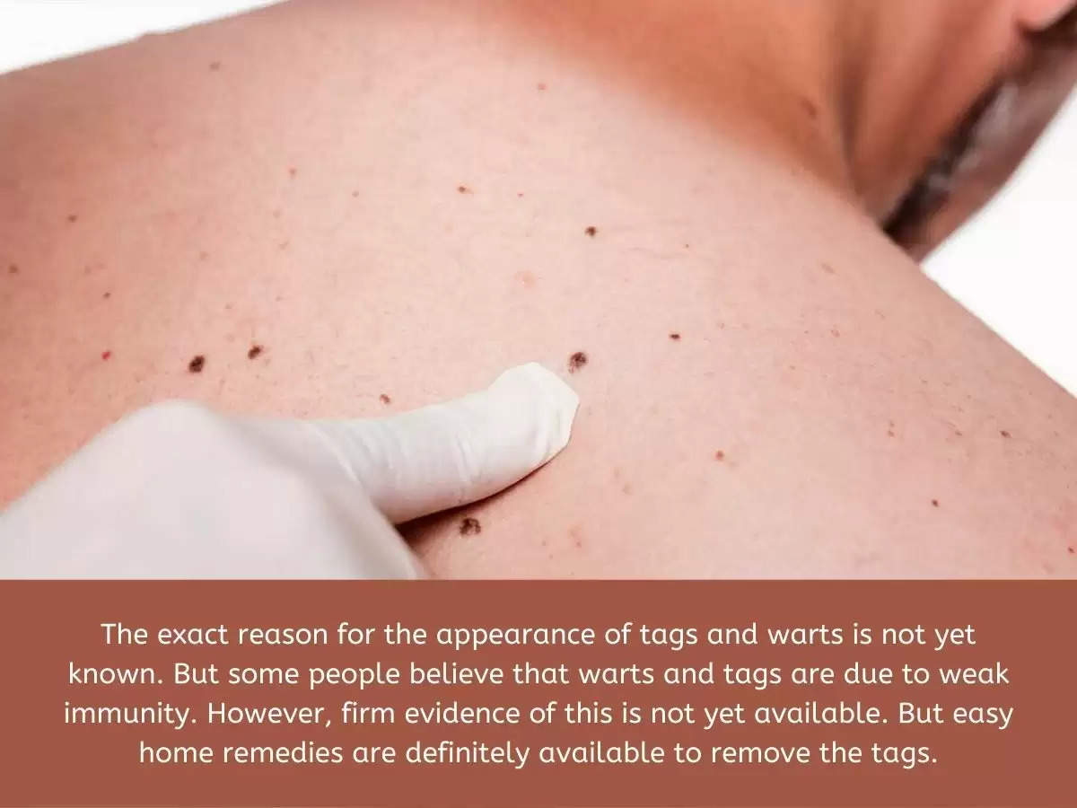 Skin Care Tips for remove Warts and Tags