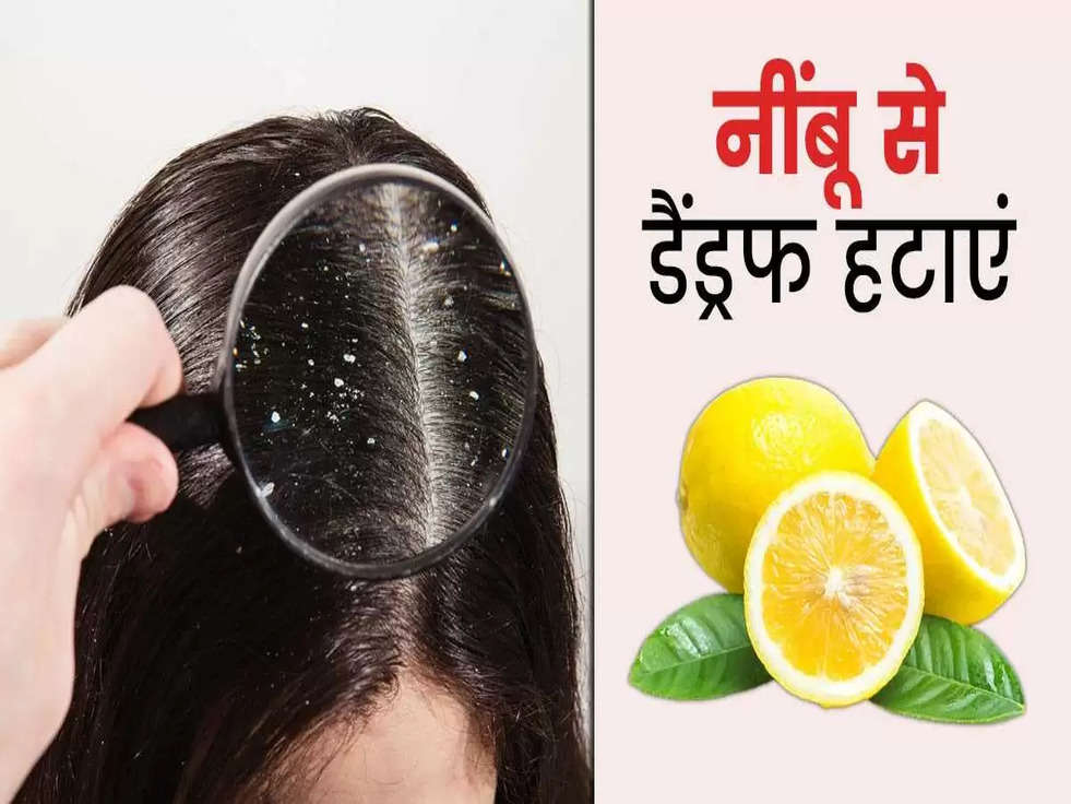 Dandruff Solution