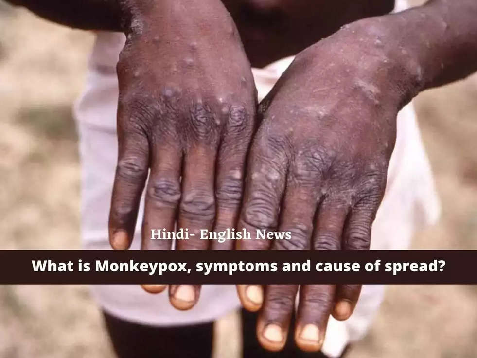 What is monkeypox, know its symptoms and cause of spread?