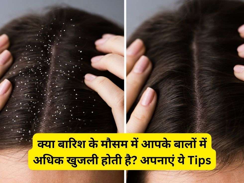 क्या बारिश के मौसम में आपके बालों में अधिक खुजली होती है? अपनाएं ये Tips