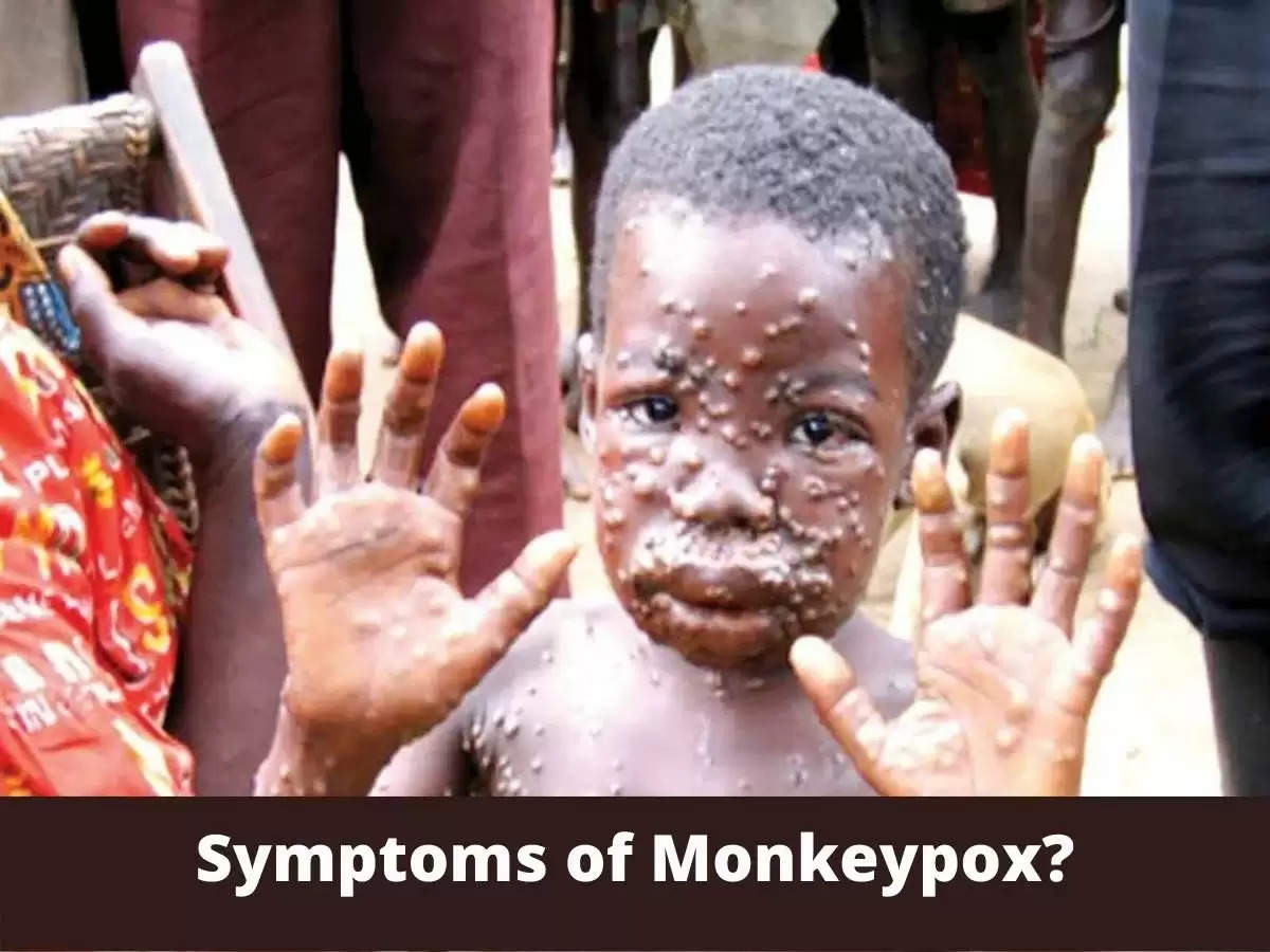 Symptoms of Monkeypox