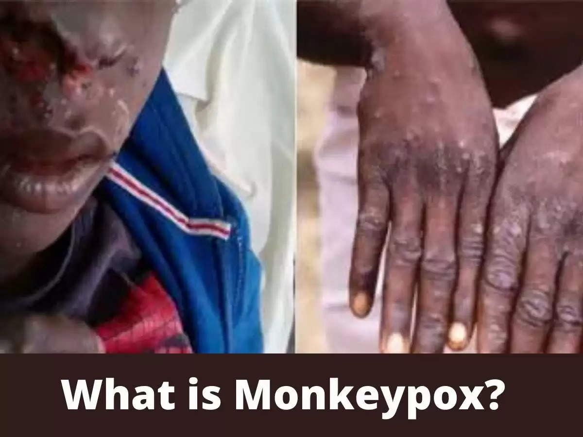 What is monkeypox?