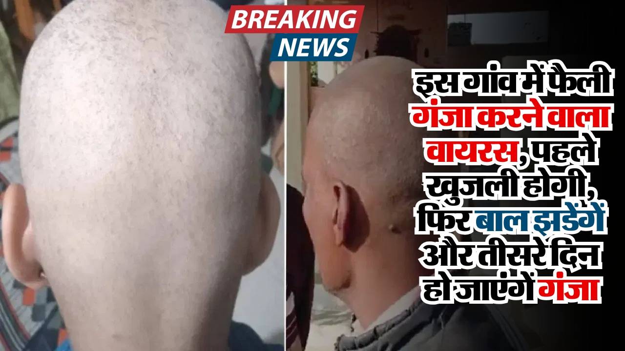 Big Breaking: इस गांव में फैली गंजा करने वाला वायरस, पहले खुजली होगी, फिर बाल झडेंगें और तीसरे दिन हो जाएंगें गंजा